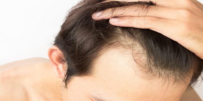 5 Reasons Why You Shouldn't Get a Hair Transplant Abroad